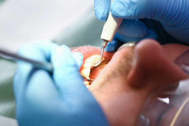 Best Knocked-Out Tooth (Avulsed Tooth) Treatment in Bluffton, SC